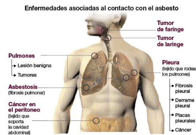 Amianto e Incapacidad Permanente