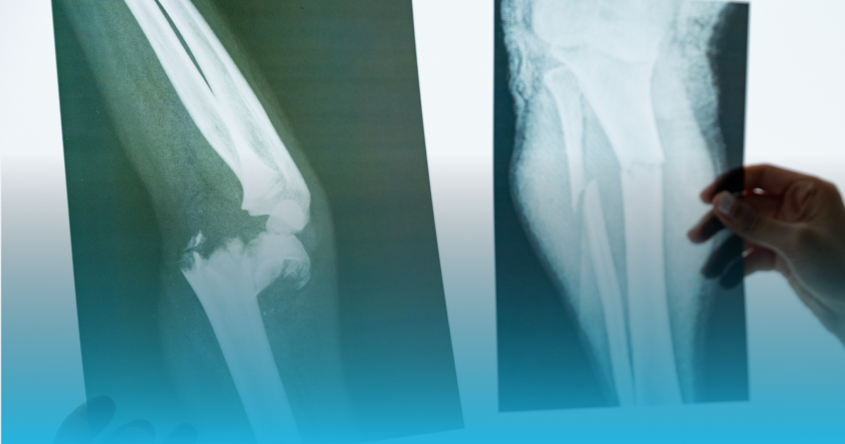 Osteoporosis e incapacidad permanente