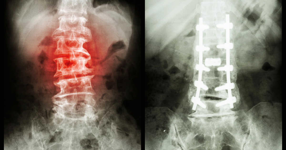 Incapacidad por espondilosis