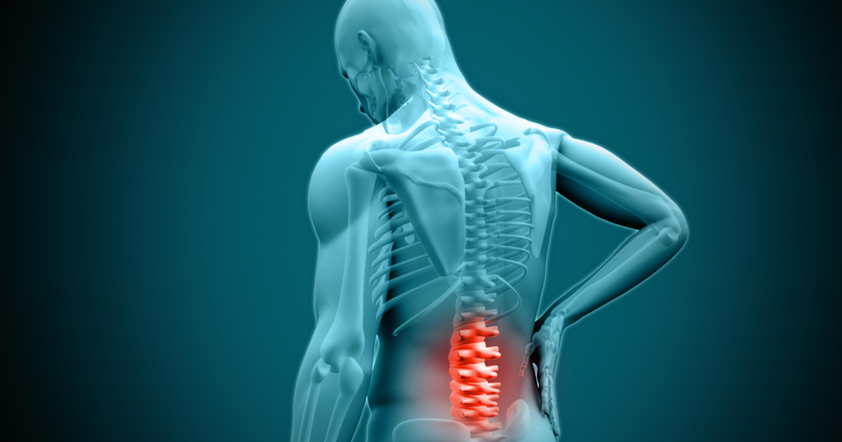 Incapacidad por radiculopatia