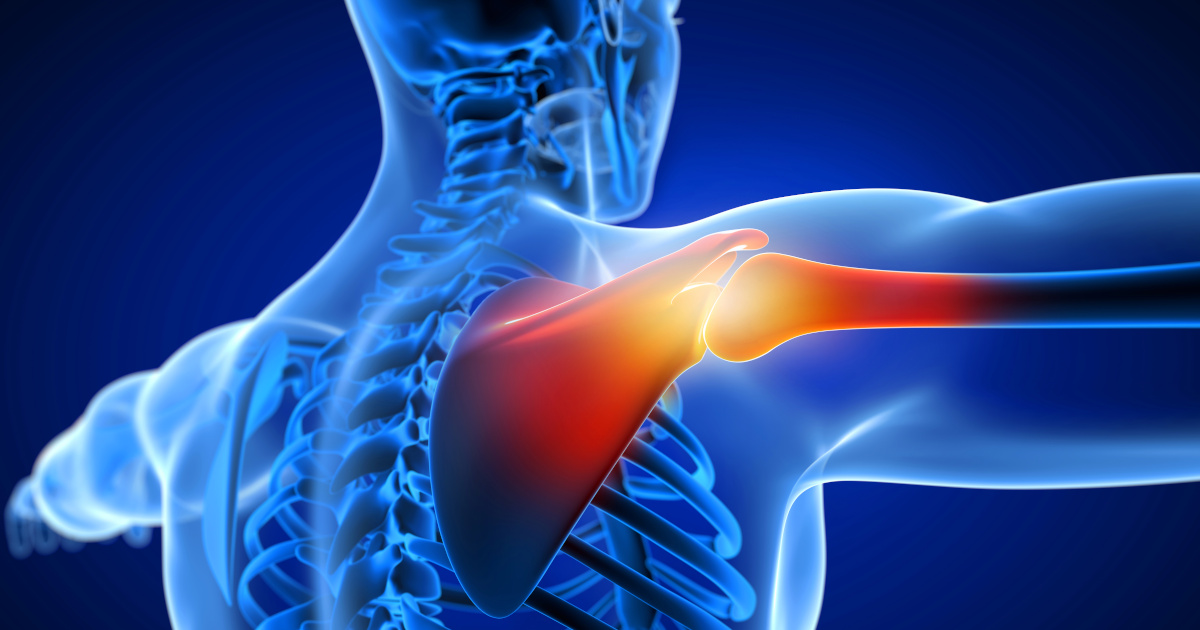 Incapacidad por síndrome subacromial